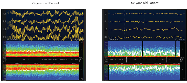 masimo_next_generation_sedline_22_year_old_59_year_old_patient