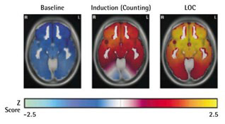 Masimo - EEG Power Shift Diagram showing shifts in EEG power at induction and loss of consciousness