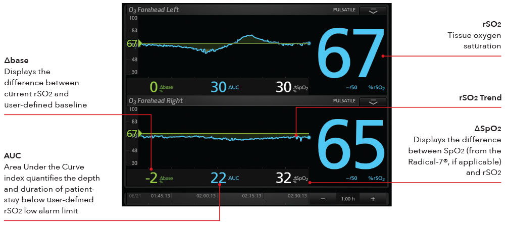 Masimo - O3 Display Cerebral Oximetry